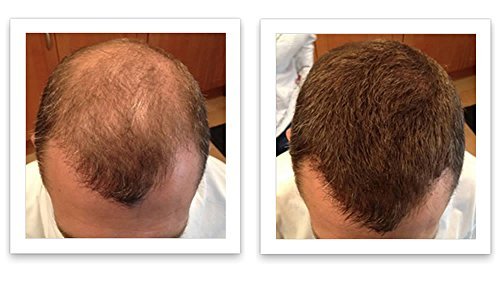 Corrector de pérdida de cabello marrón mediano