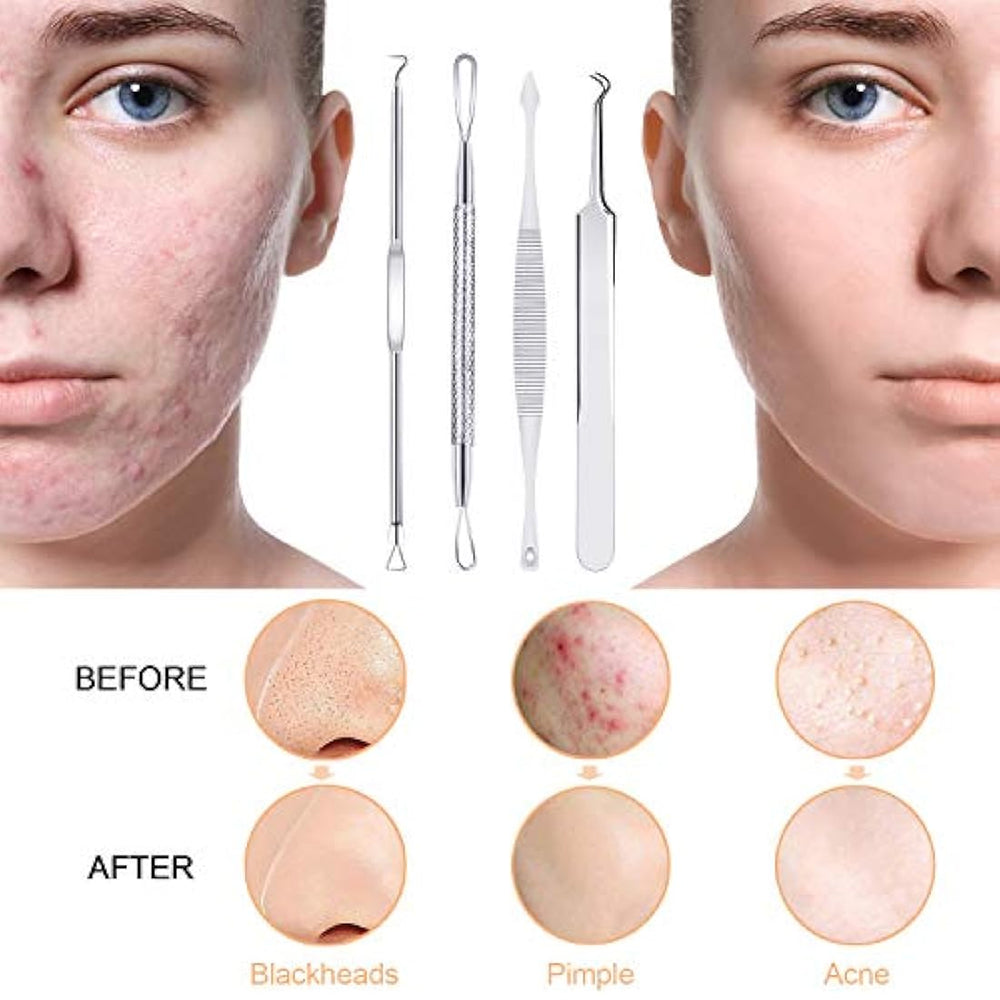 Kit de herramientas para removedor espinillas, 10 unidades, herramienta extractora de espinillas, kit de acné para puntos negros, puntos blancos, eliminación de zit