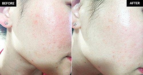 Crema para las manchas faciales