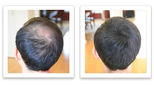 Corrector de pérdida de cabello marrón mediano