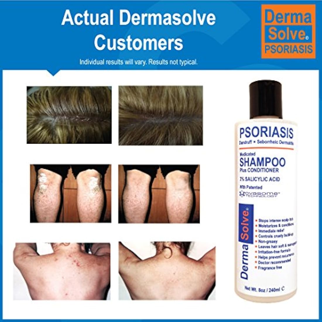 Champú para cuero cabelludo con caspa