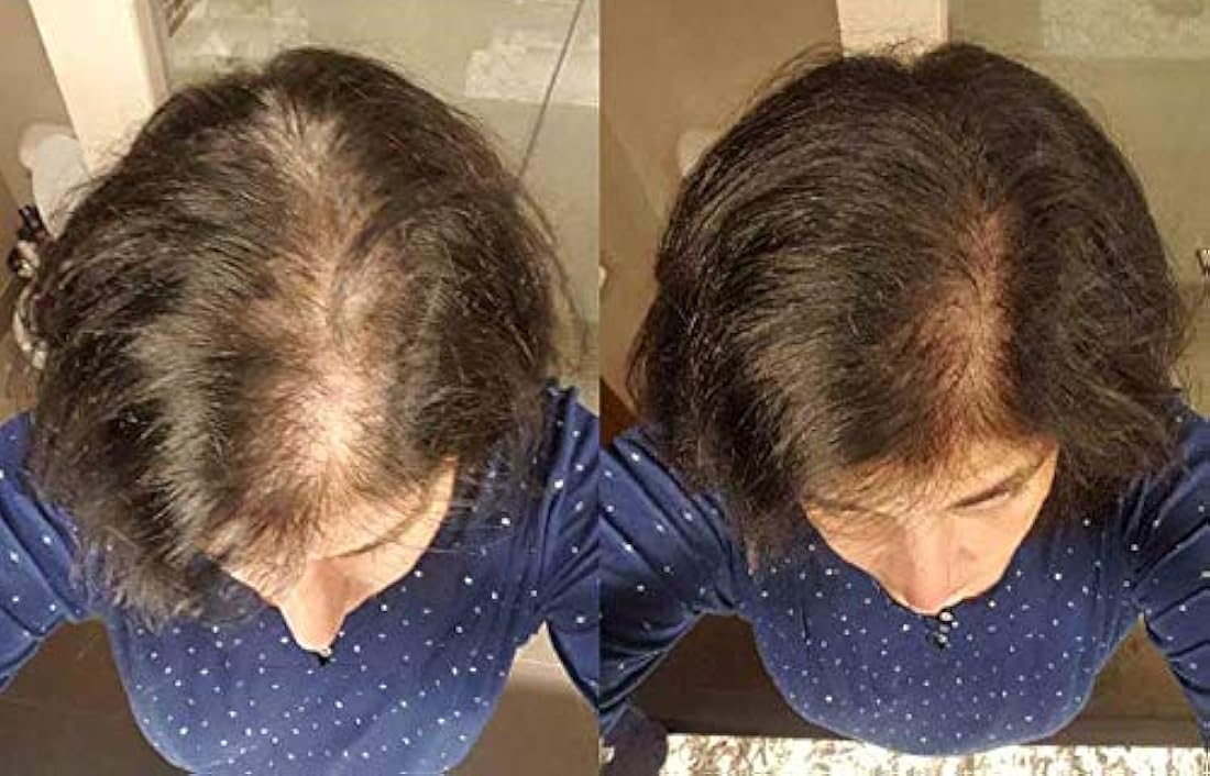 Tratamiento capilar para Mujer