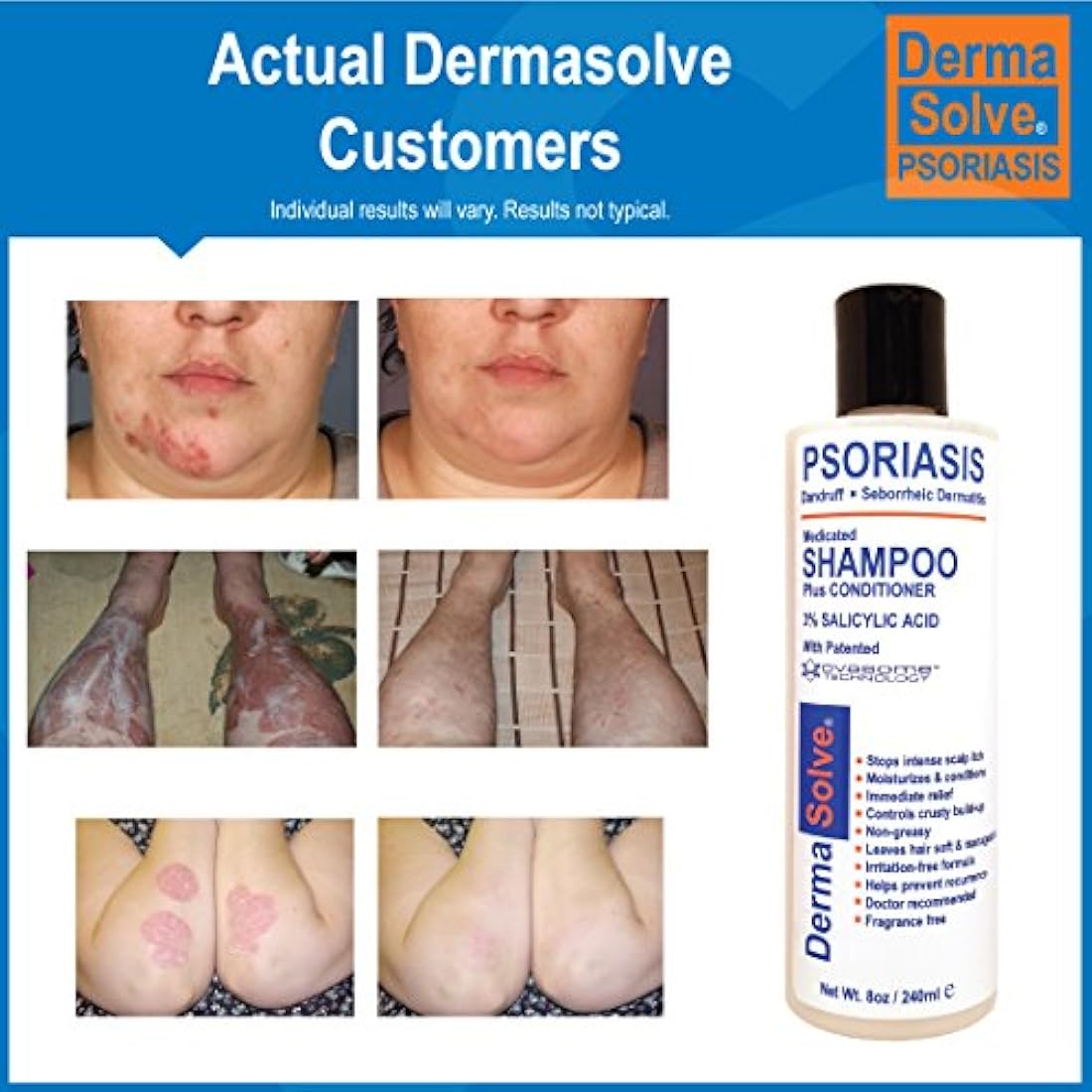 Champú para cuero cabelludo con caspa