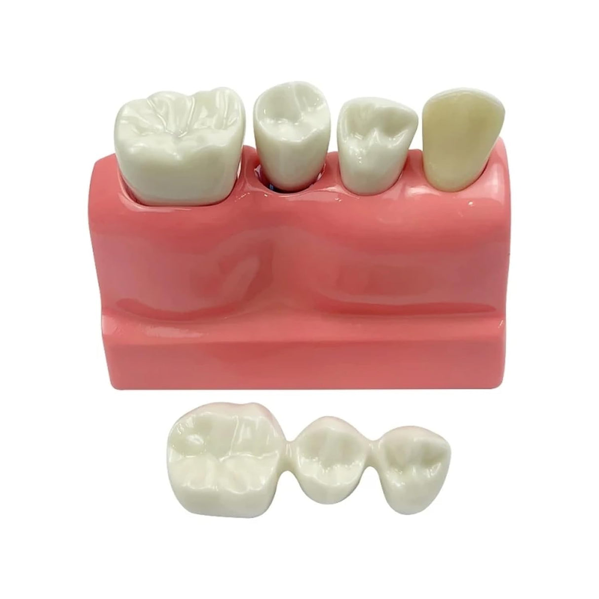 Modelo de Implante Dental con Puente de Coronas Removibles