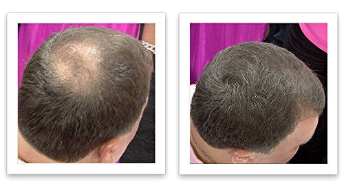 Corrector de pérdida de cabello marrón mediano