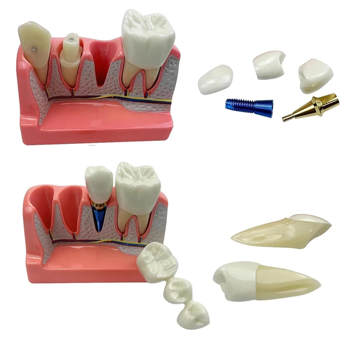 Modelo de Implante Dental con Puente de Coronas Removibles