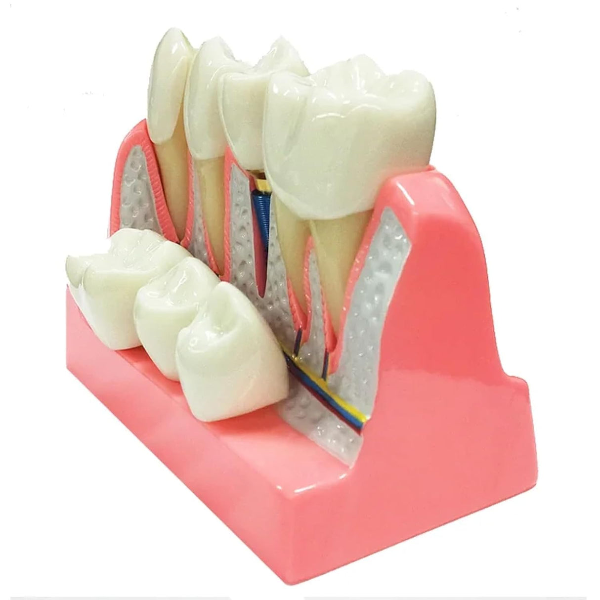 Modelo de Implante Dental con Puente de Coronas Removibles