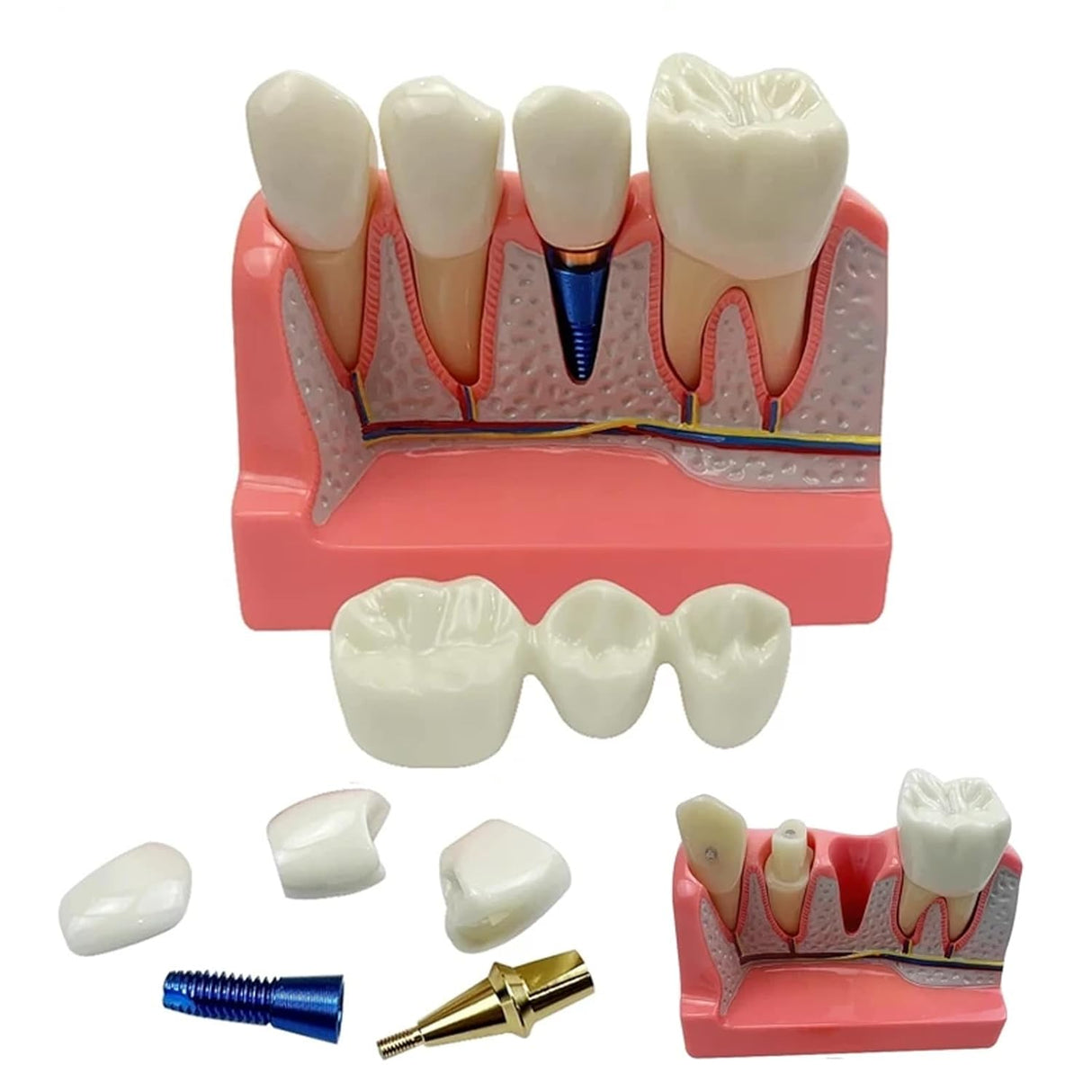 Modelo de Implante Dental con Puente de Coronas Removibles