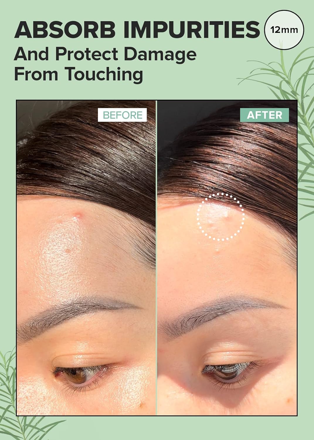 Parche Hidrocoloide para Acné con Árbol de Té -