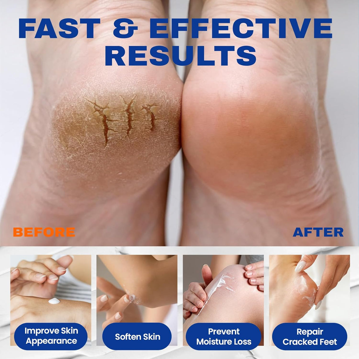 Crema de Urea 40% para Pies, 2% Ácido Salicílico, 5.29 oz