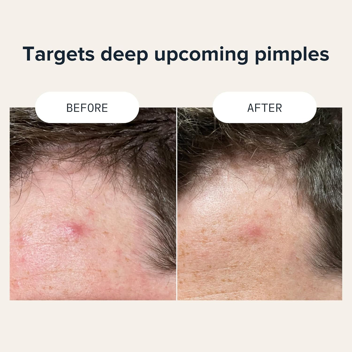 Cardon Parches de espinillas tratamiento acné puntos negros