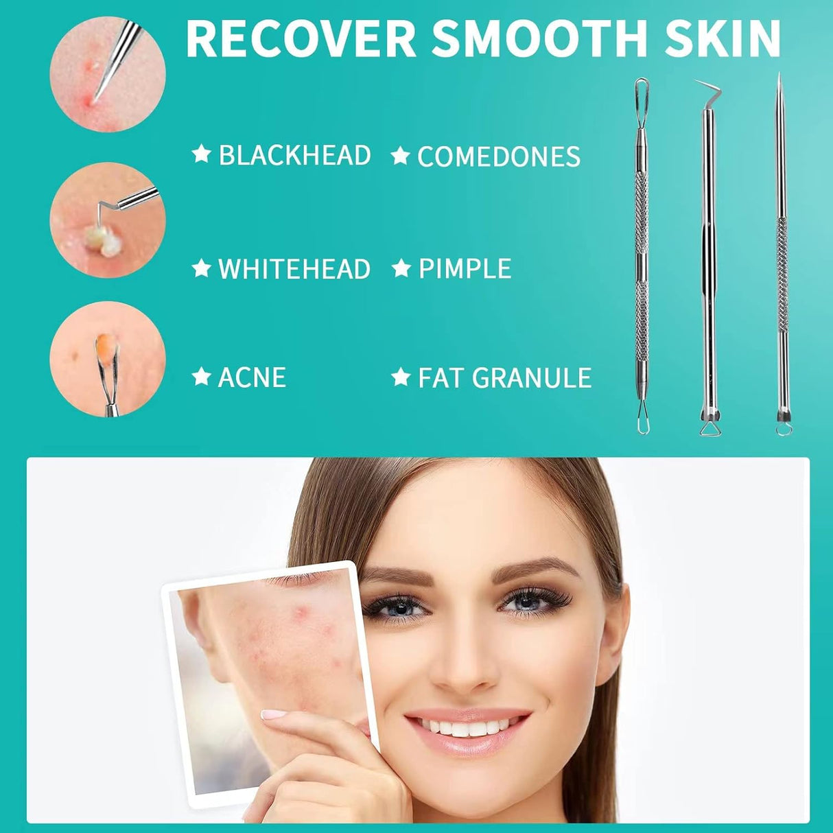Extractor de espinillas WSYUB, acero inoxidable, kit de acné