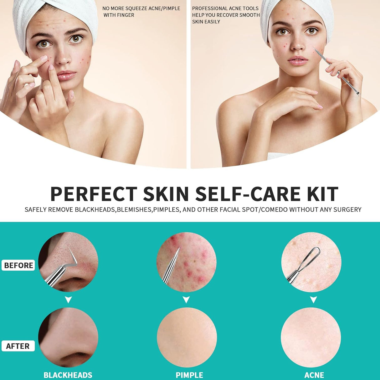 Extractor de espinillas WSYUB, acero inoxidable, kit de acné