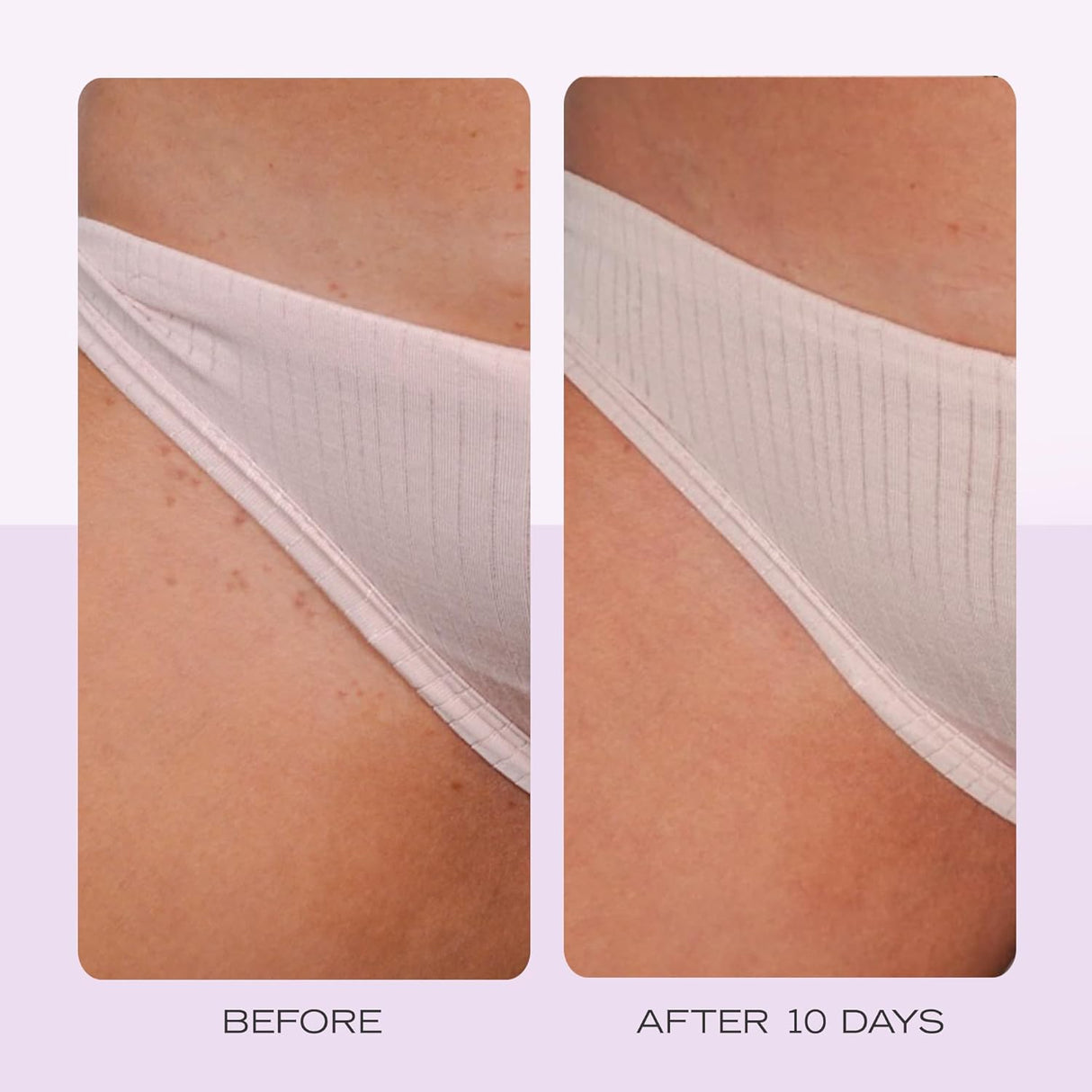 Toallitas para vellos encarnados - First Aid Beauty - 28 Pads