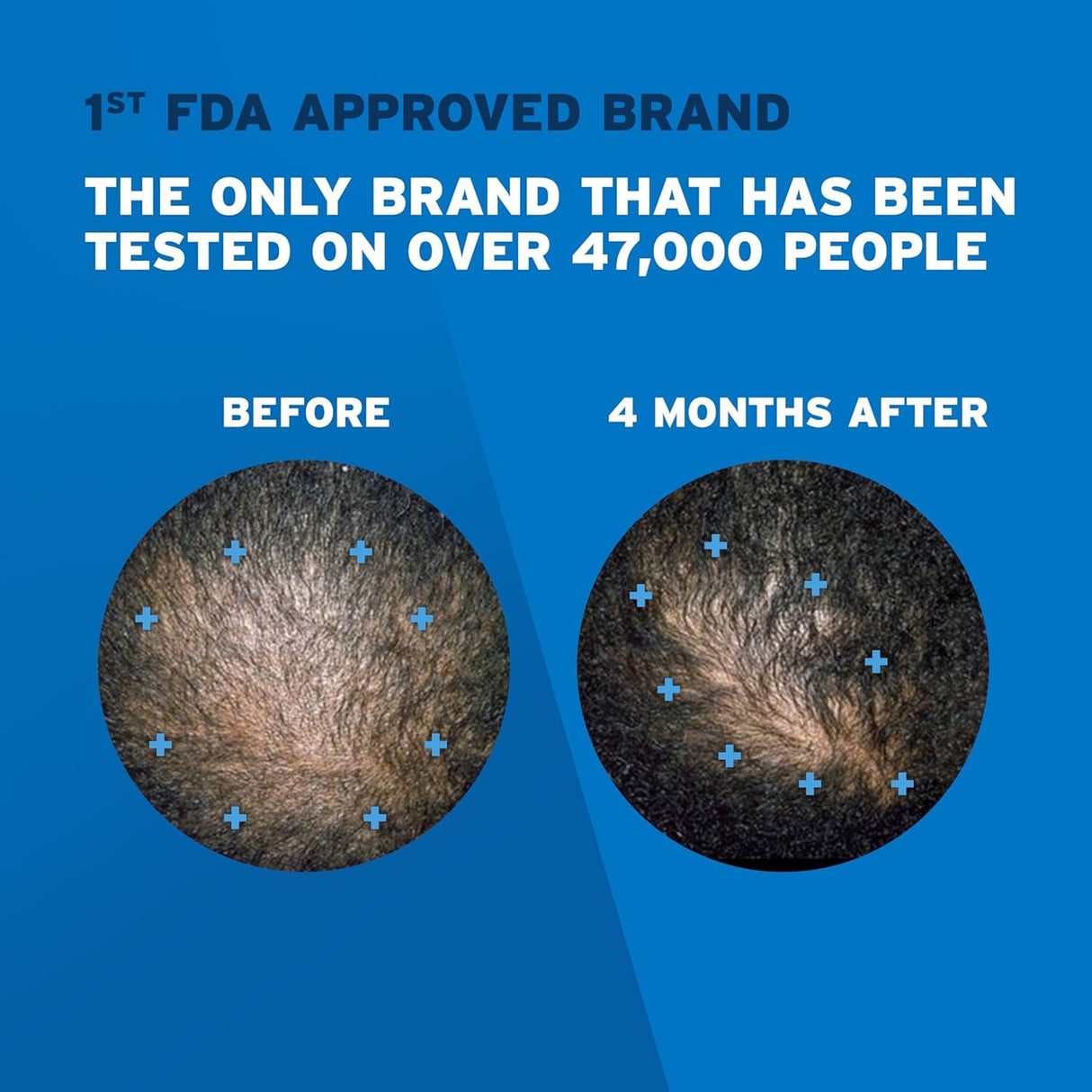 Cuidado de cabello hombres rogaine Espuma suministro