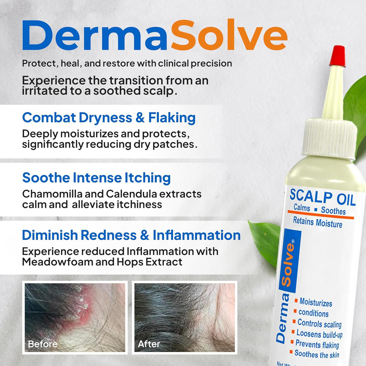 Dermasolve Aceite de cuero cabelludo para psoriasis