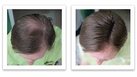 Corrector de pérdida de cabello marrón mediano
