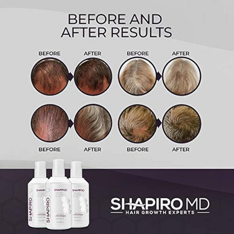 Champú para la pérdida de cabello Bloqueadores DHT