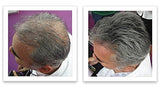 Corrector de pérdida de cabello