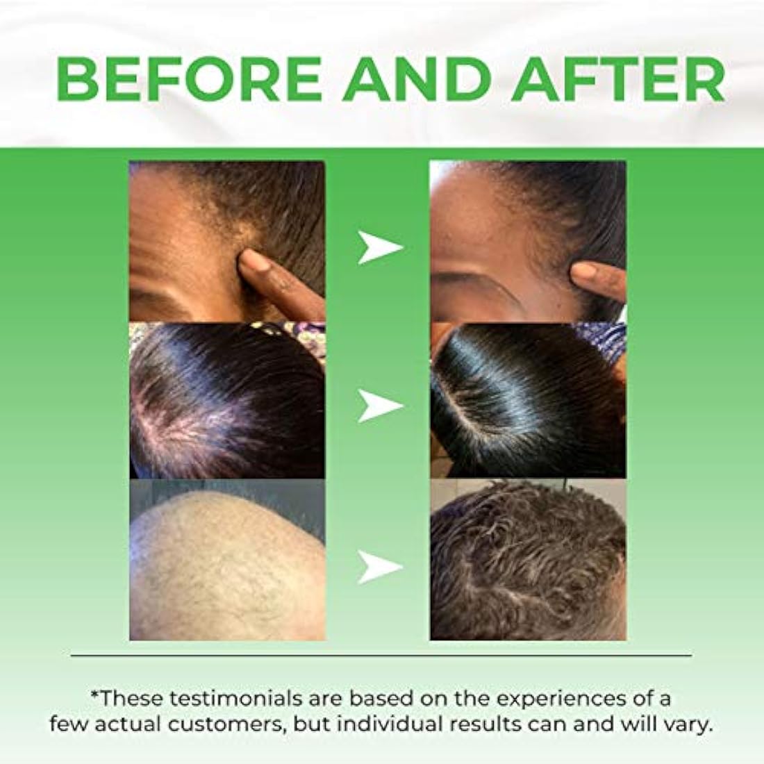 Fórmula tópica avanzada para crecimiento del cabello