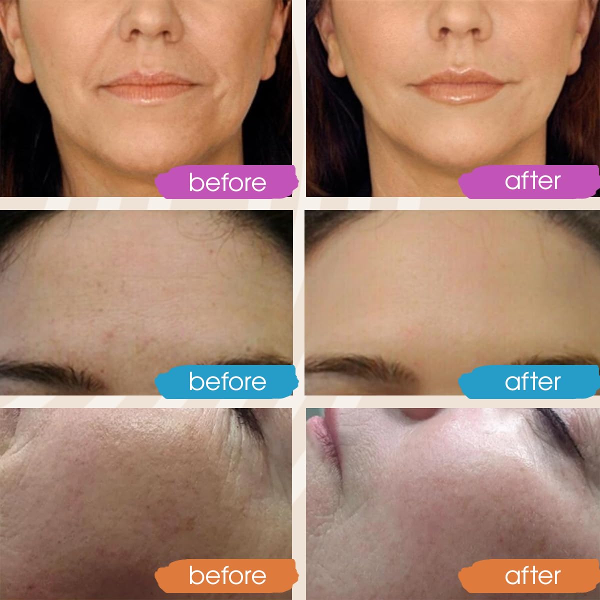Suero Facial de Retinol y Ácido Hialurónico Hidratante Nocturno