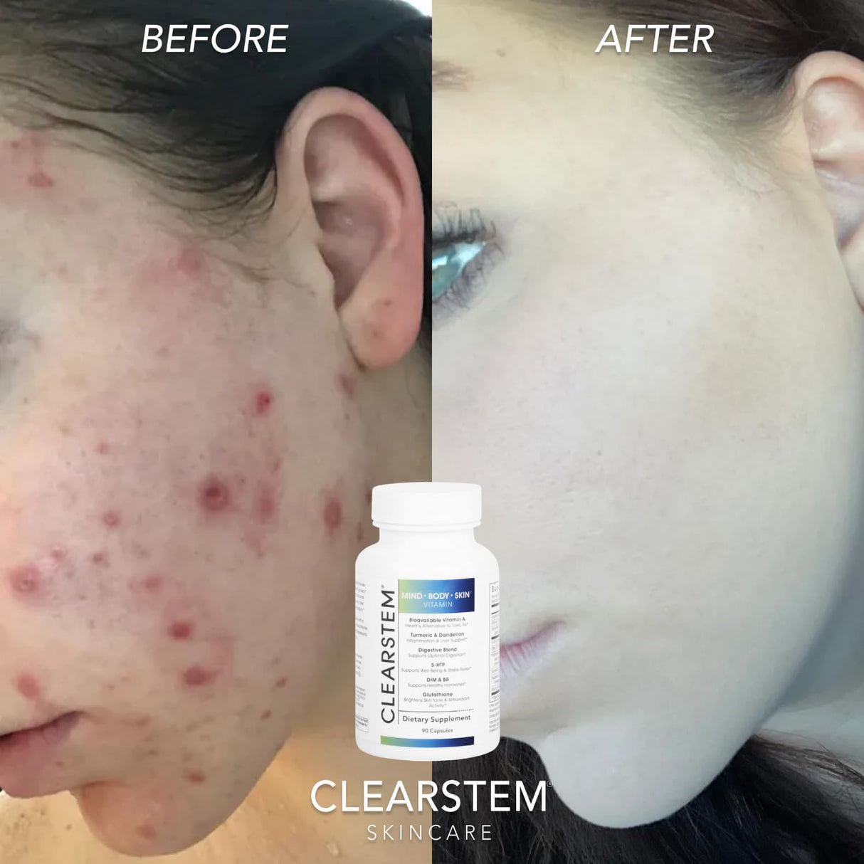Suplemento hormonal para el acné 5HTP CLEARstem