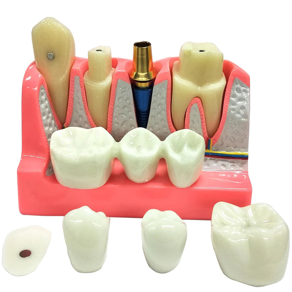 Modelo de Implante Dental con Puente de Coronas Removibles