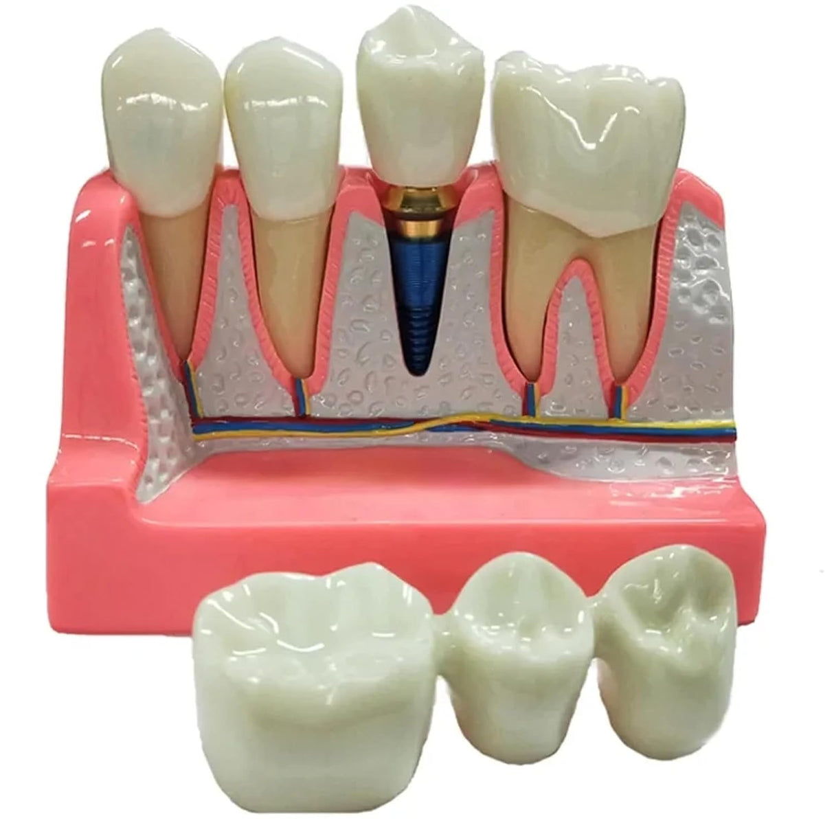 Modelo de Implante Dental con Puente de Coronas Removibles