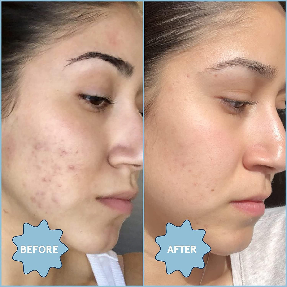 Aceite Facial para Acné y Minimizador de Poros