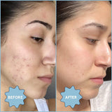 Aceite Facial para Acné y Minimizador de Poros