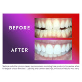 Kit de Blanqueamiento Dental LED ComfortFit con Bolígrafo