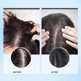 Exfoliante para el cuero cabelludo tratamiento con picazón