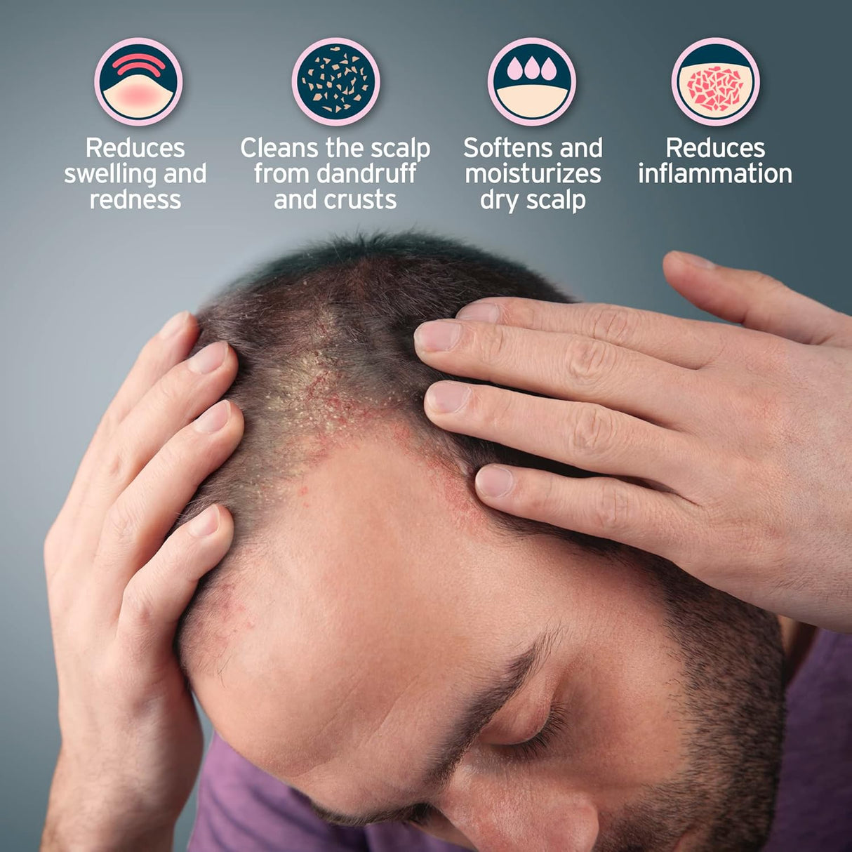 Champú para dermatitis seborreica ácido salicílico Sphagnum
