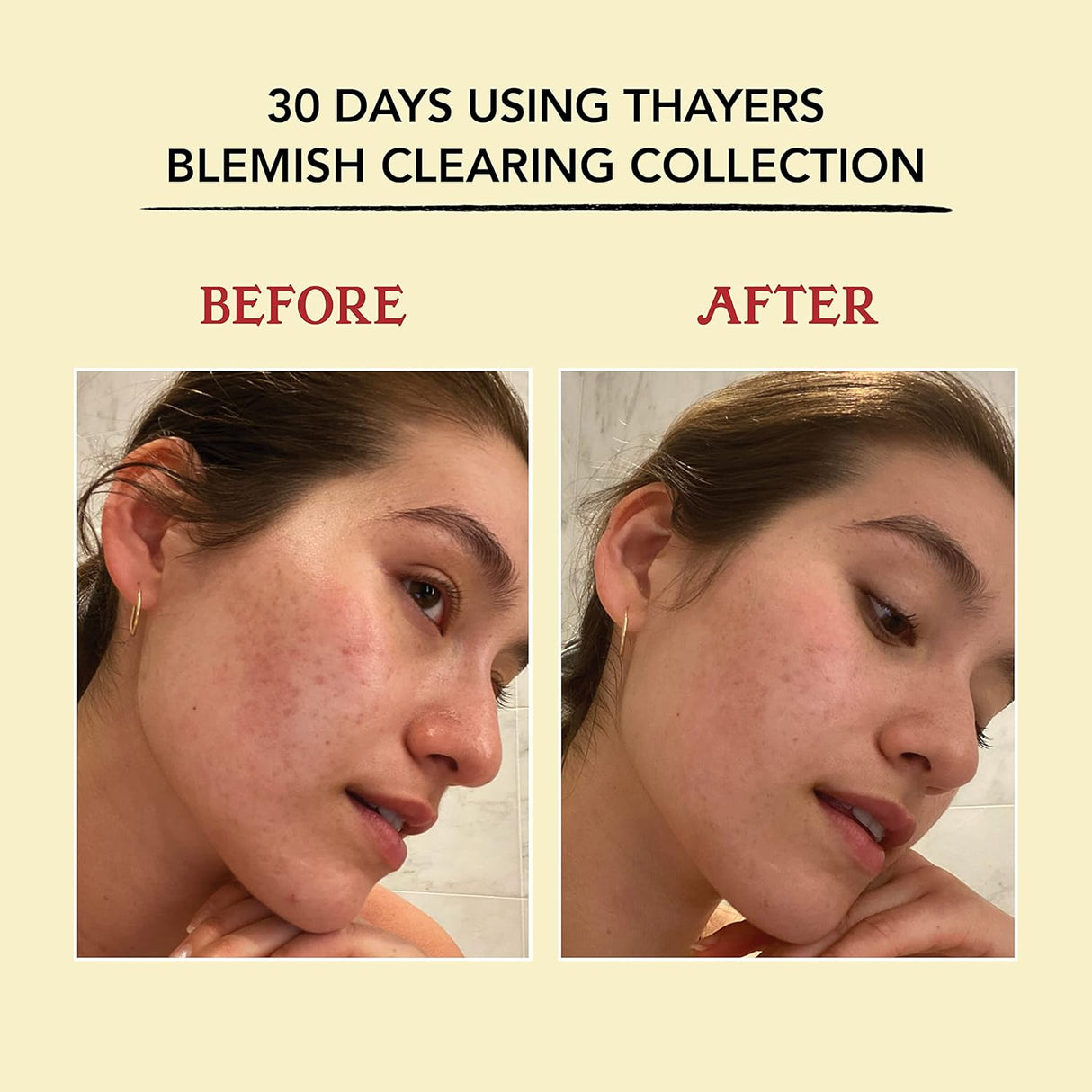 Cuidado Facial Tónico facial para acné con ácido salicílico