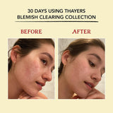 Cuidado Facial Tónico facial para acné con ácido salicílico