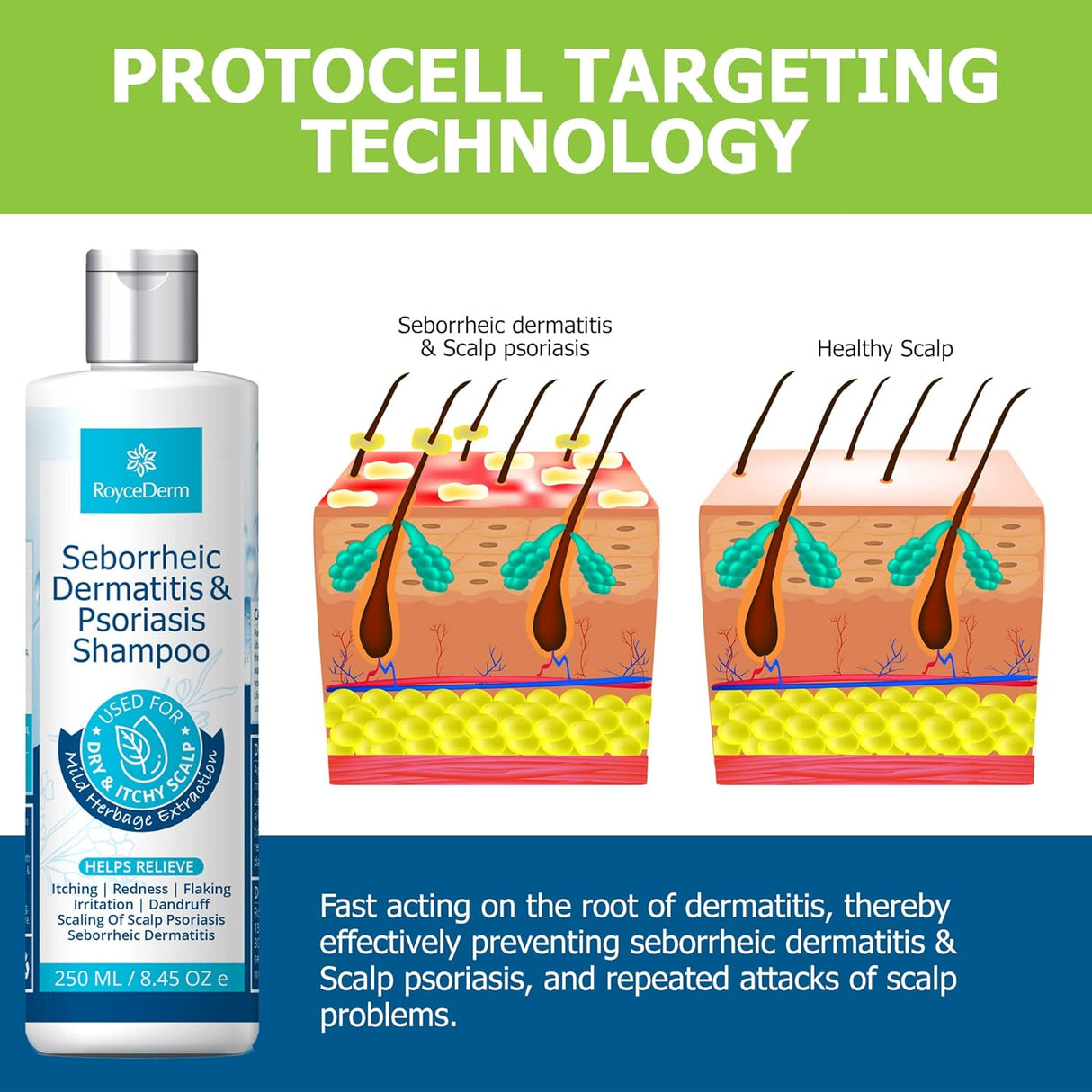 Roycederm Champú para la psoriasis para dermatitis
