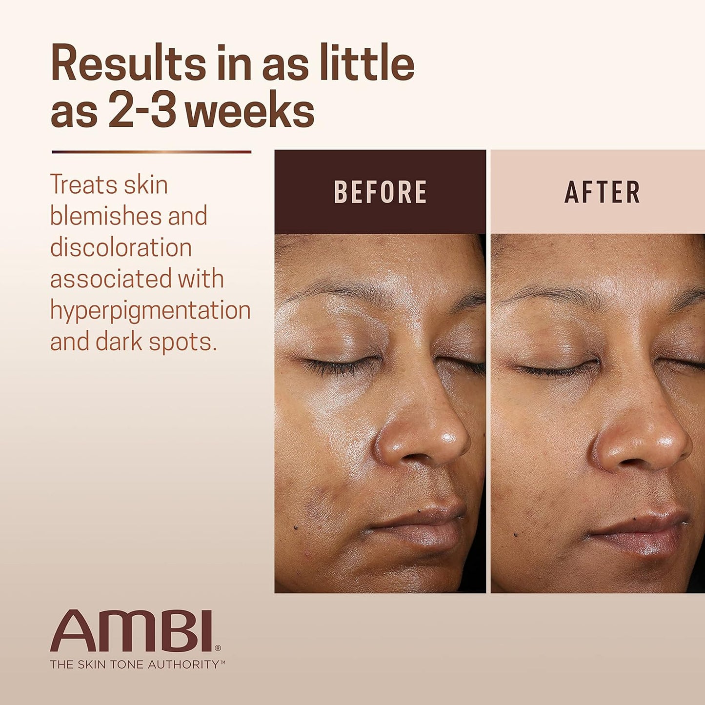 Tratamiento de hiperpigmentación Ambi corrector de manchas