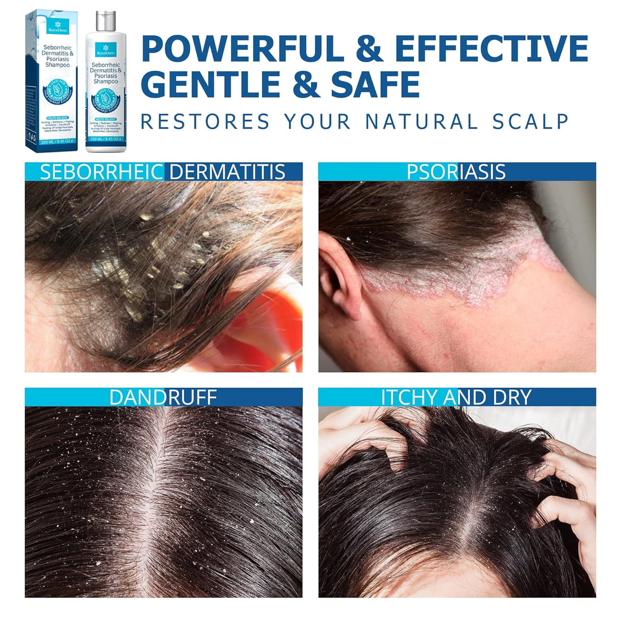 Roycederm Champú para la psoriasis para dermatitis
